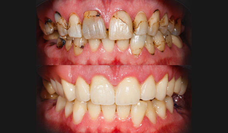 A Step-by-Step Guide to Full Mouth Reconstruction