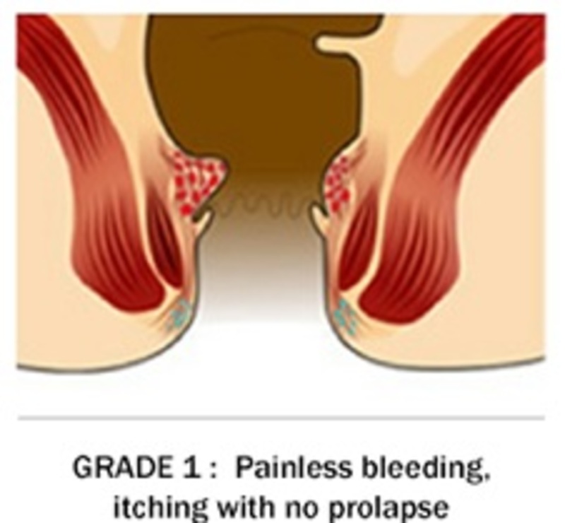 Piles Treatment in Thane