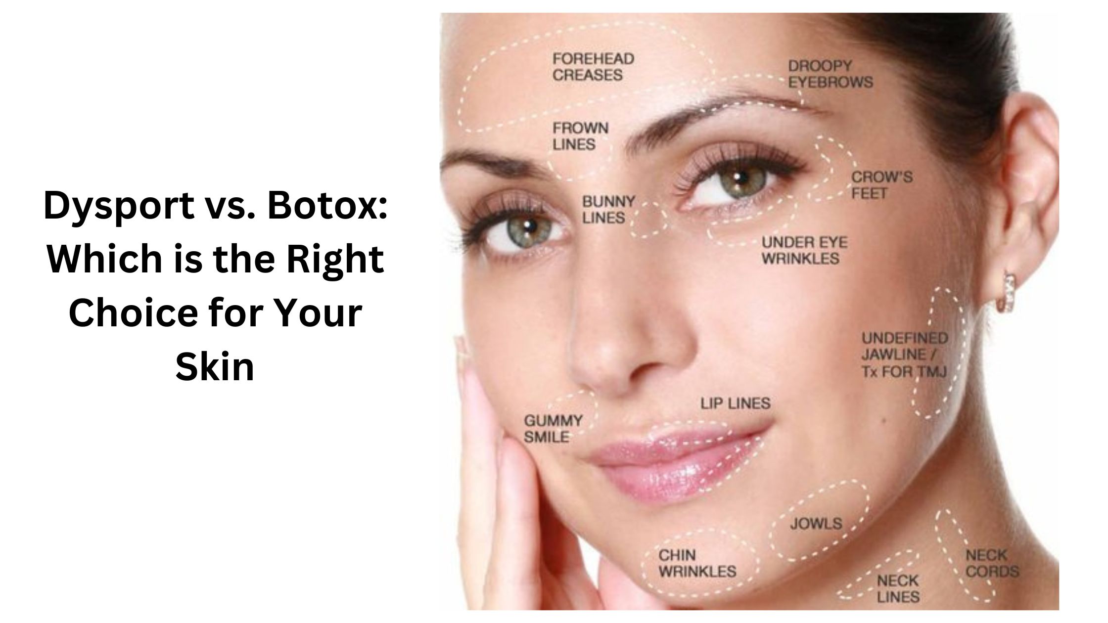  Dysport vs. Botox: Which is the Right Choice for Your Skin