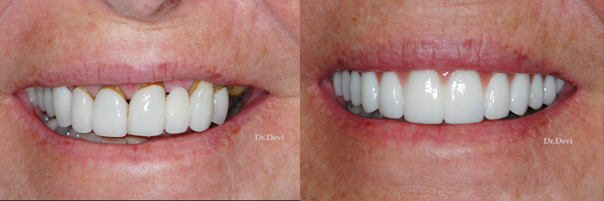 Revitalize Your Smile with ALL ON 4 Dental Implants: A Comprehensive Guide