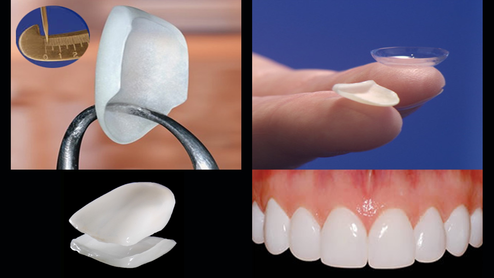 Dental Veneers Market Growth Trajectory Through 2024-2033