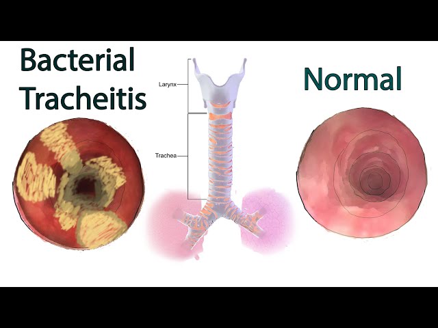 Global Tracheitis Treatment Market Growth Analysis 2024 – Forecast Market Size And Key Factors Driving Growth