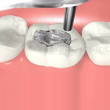 Global Tooth Filling Materials Market Analysis 2024 – Estimated Market Size And Key Drivers