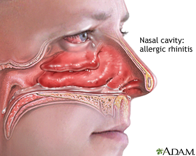 Allergic Rhinitis Market Growth Outlook Through 2024-2033