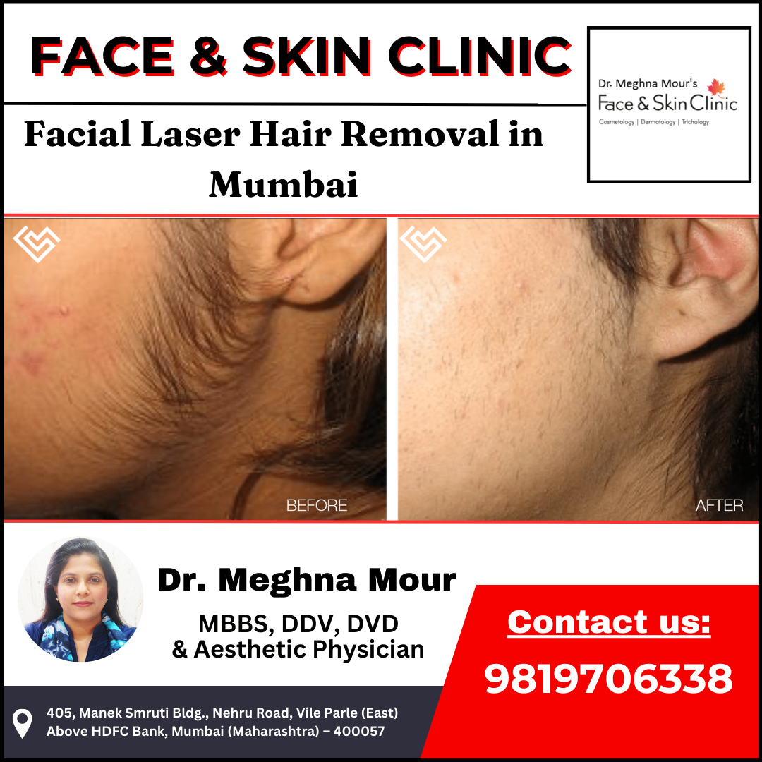 Laser Accuracy Facial Hair Removal in Mumbai