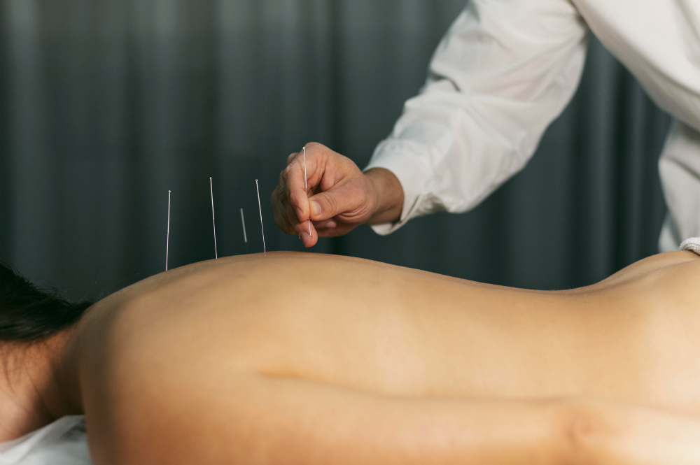 Explore The Stress-Relieving Power Of Acupuncture!