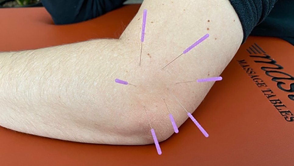 Finding Relief: How Acupuncture Can Help with Tennis Elbow