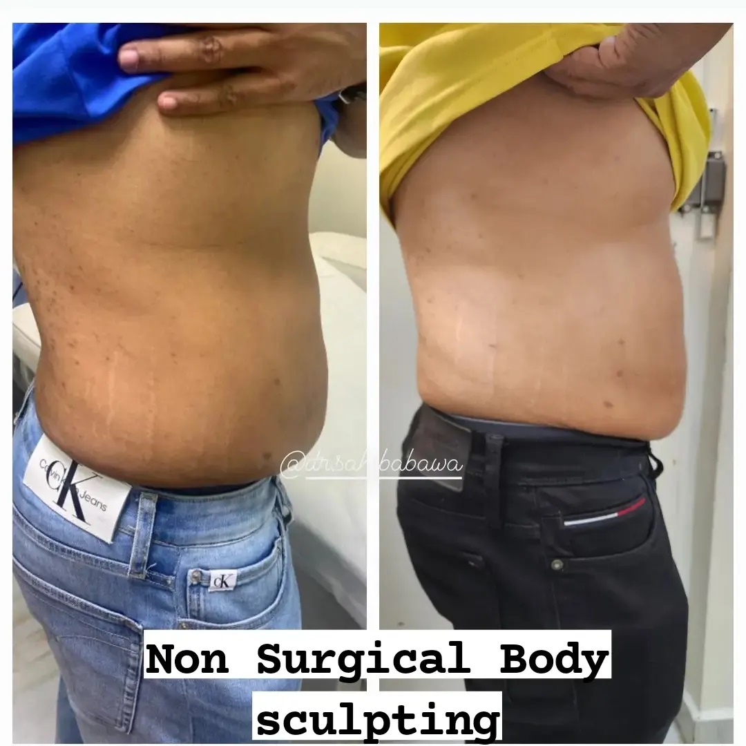 Why Choose an Aesthetic Skin Clinic for Belly Skin Tightening Treatments?