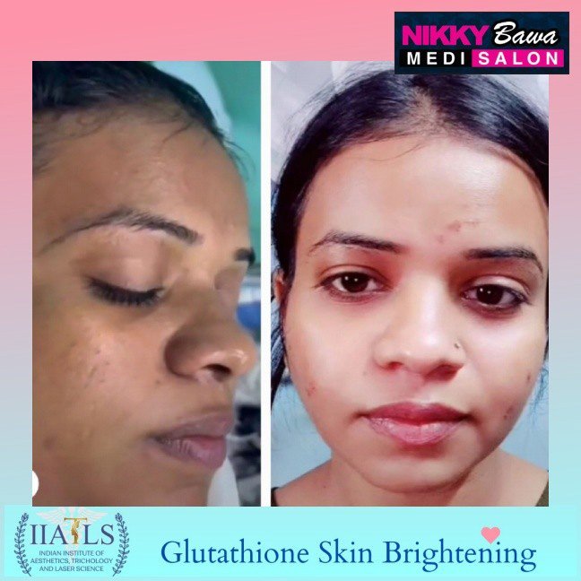 Struggling with Uneven Skin Tone? Try Skin Whitening Treatment in Bhopal
