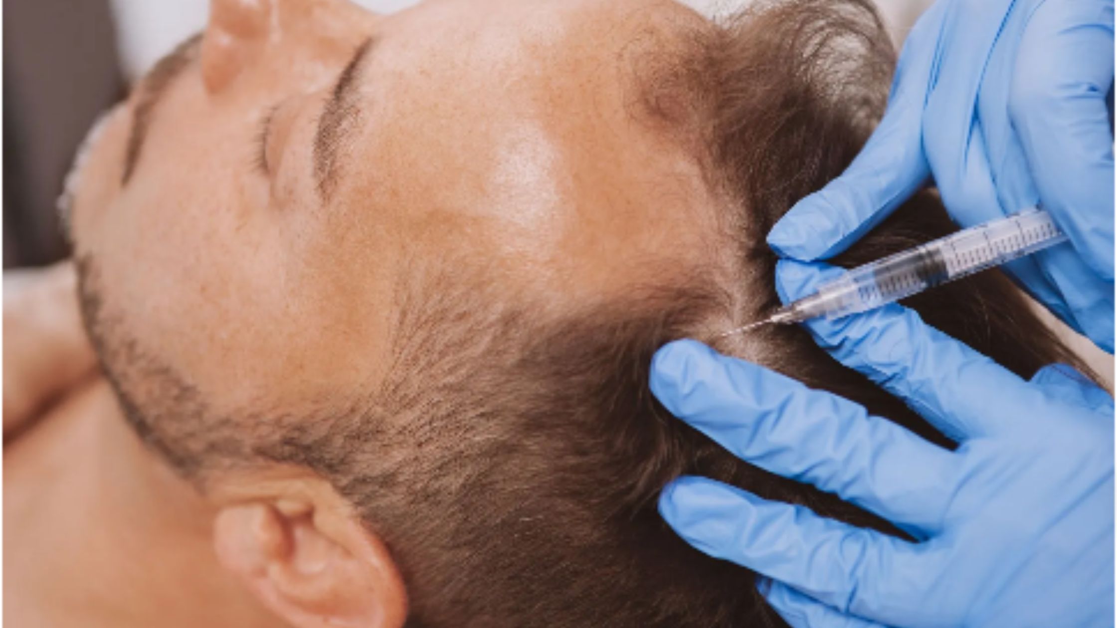 Transform Your Skin with PRP: Common Uses and Benefits