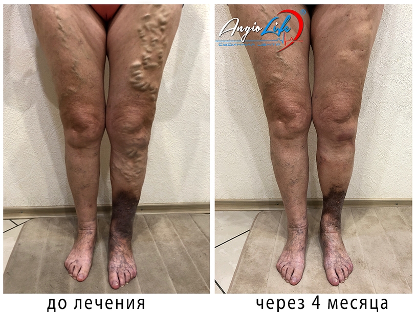 Compassionate Vascular Experts at AngioLife