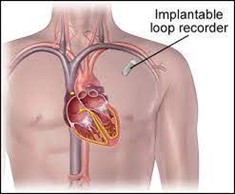 Implantable Loop Recorders Market Size, Share, Regional Overview and Global Forecast to 2032