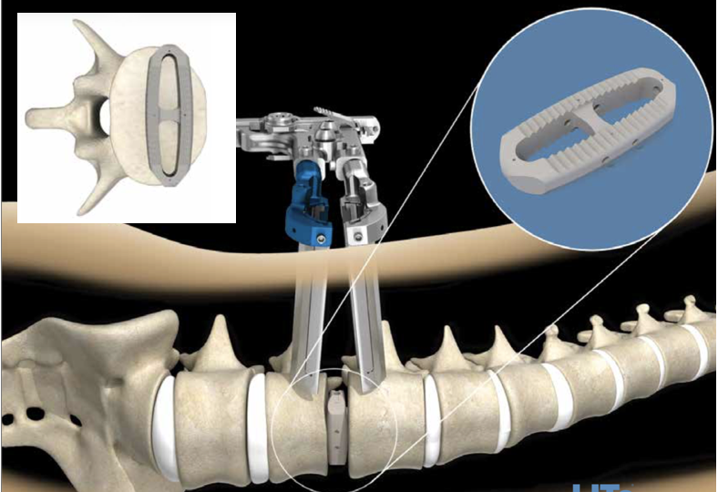 Extreme Lateral Interbody Fusion (XLIF) Surgery Market Size, Status, Growth | Industry Analysis Report 2023-2032