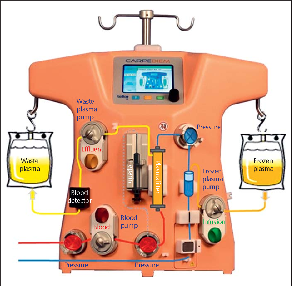 Global Therapeutic Plasma Exchange Market Report, Latest Trends, Industry Opportunity & Forecast to 2032