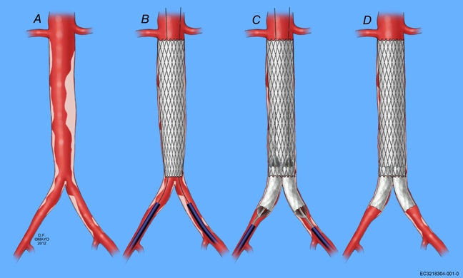 Iliac Stent Market | Global Industry Trends, Segmentation, Business Opportunities & Forecast To 2032
