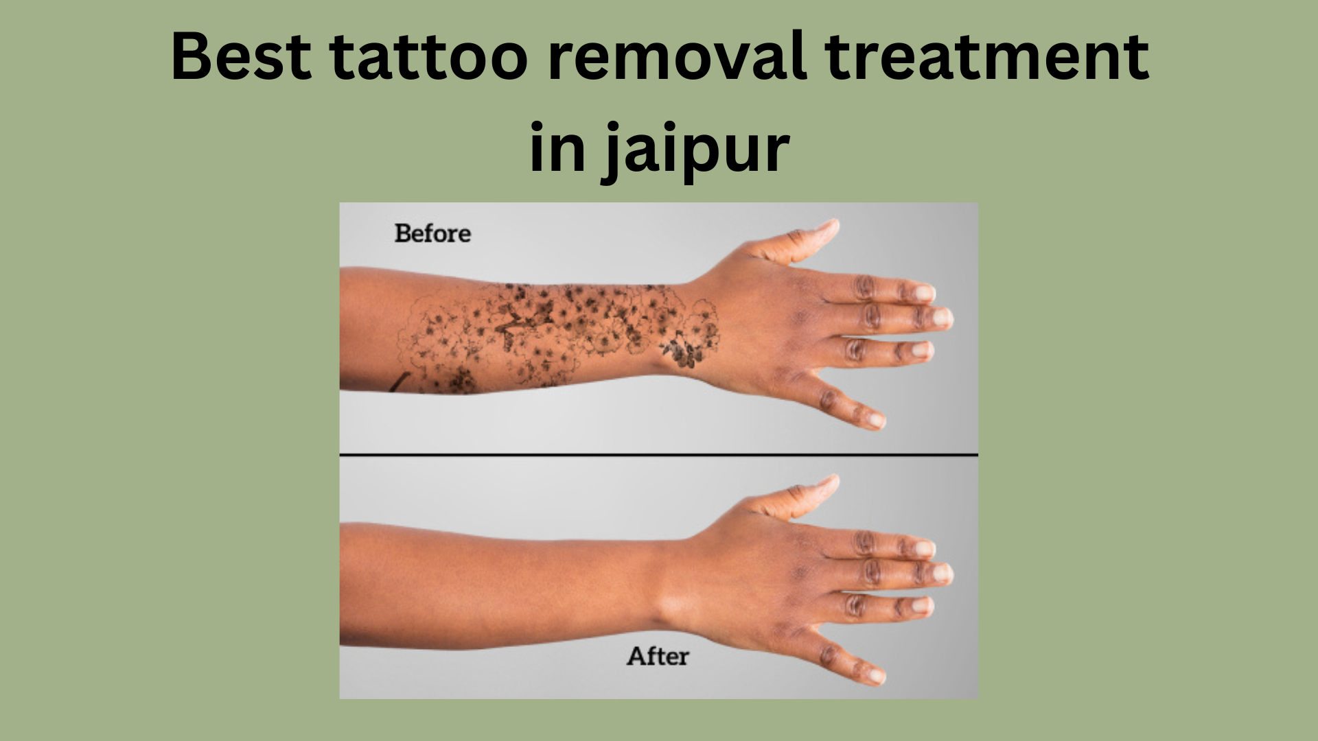 How Do You Choose the Best Tattoo Removal Treatment in Jaipur?