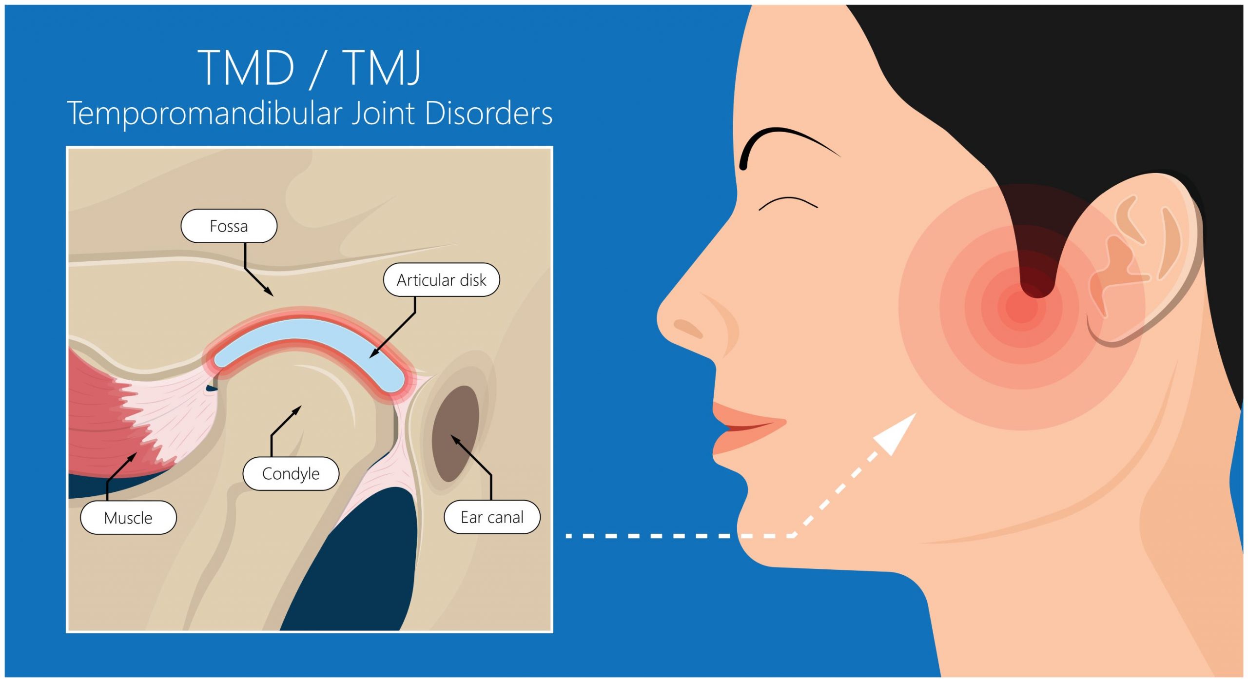 Understanding and Seeking TMJ Treatment: Impact, Benefits, and Importance