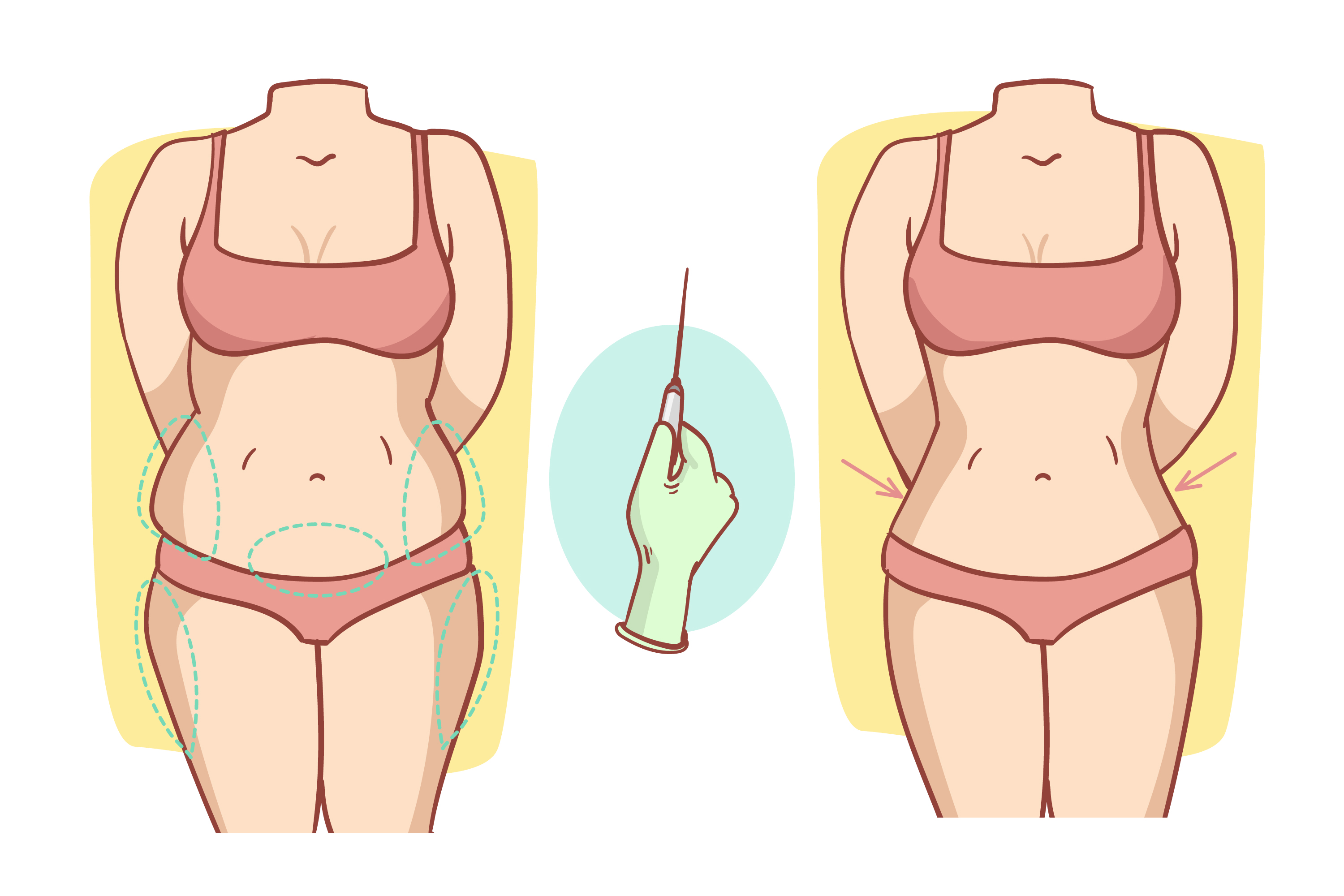 How Much Time Did It Take to Recovery from a Tummy Tuck?