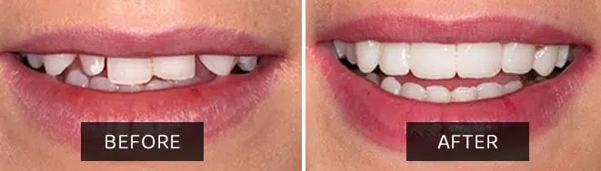 The Brisbane Veneer Experience: Transforming Smiles, Transforming Lives
