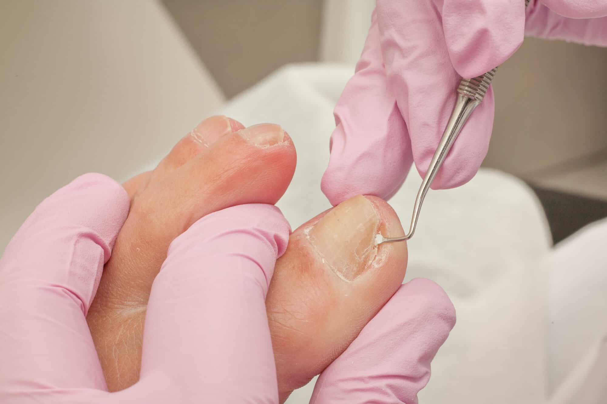 Proven Ingrown Toenail Treatment Options for Long-Lasting Relief