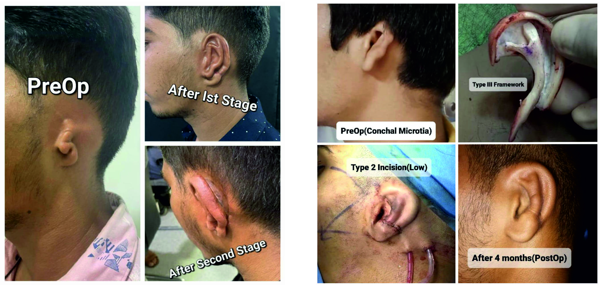 Effective Solutions for Microtia: Explore Our Surgical Expertise