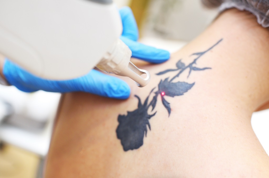 Laser Tattoo Removal in Dubai: Fast & Painless