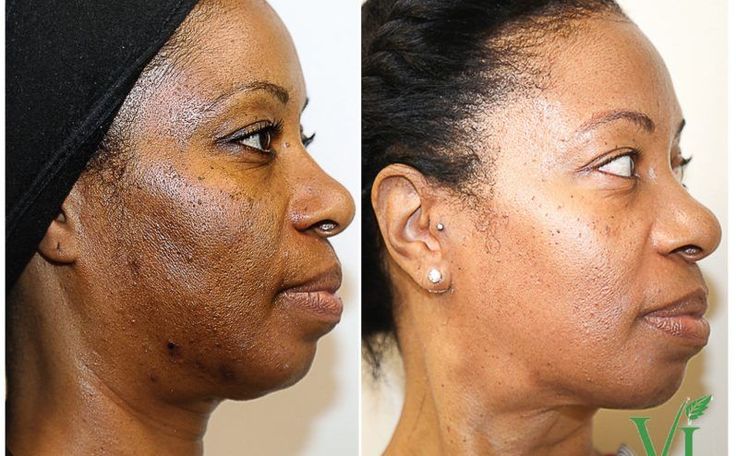 Everything You Need to Know About Hydroquinone Skin Treatment