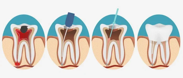 How Root Canal Treatment Can Save Your Teeth?