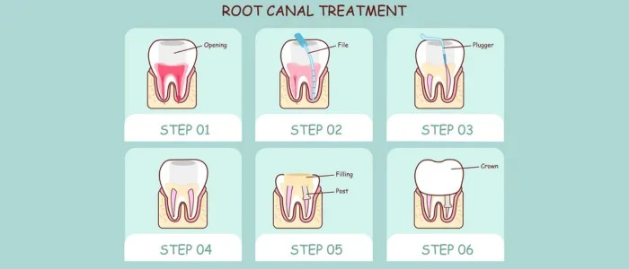 How To Save a Decayed Tooth?