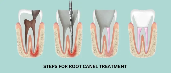 How Successful Is Root Canal Treatment?