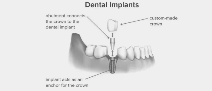 What Is a Dental Implant?