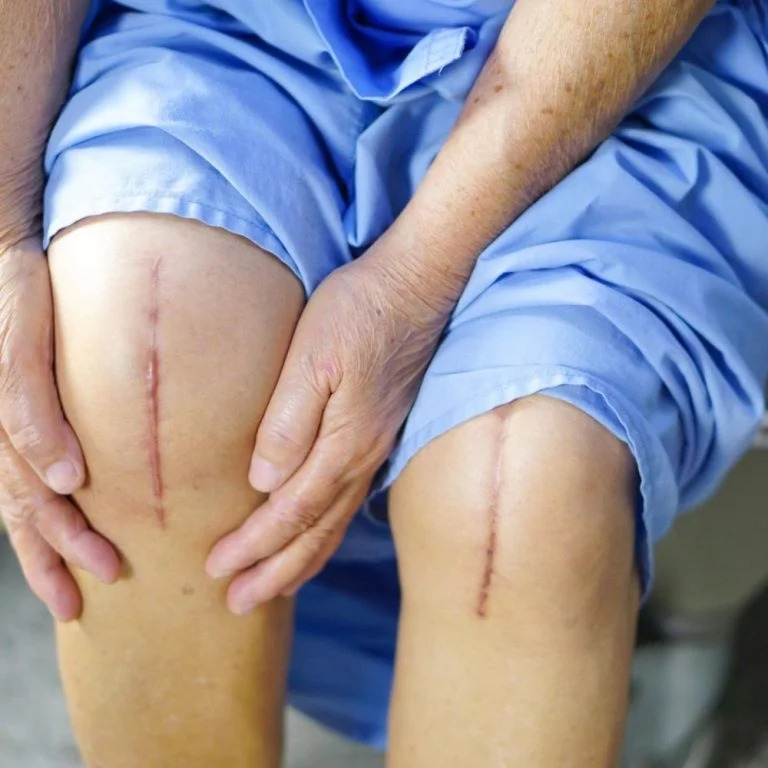 The Myth of Knee Replacement Surgery: Exploring Non-Surgical Alternatives