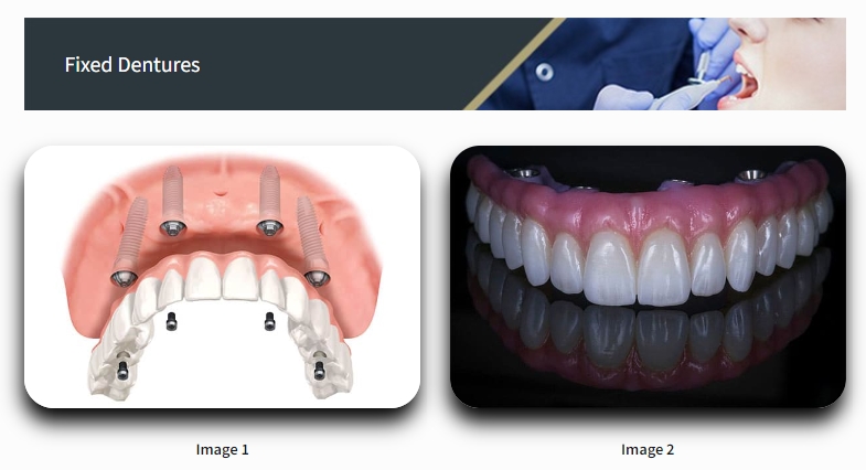 How Dental Implant Surgeons Ensure Safe Tooth Implants in Newtown PA