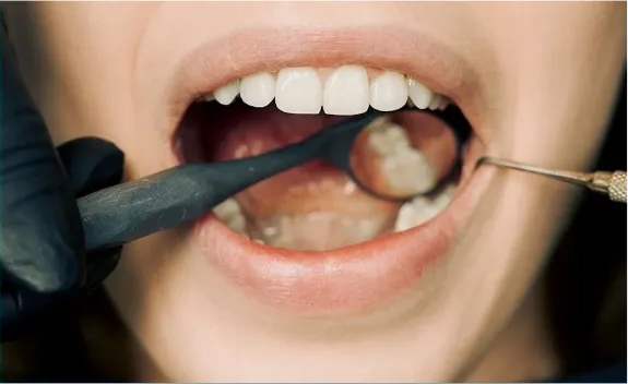 Global Dental Fluoride Treatment Market Analysis 2024-2033