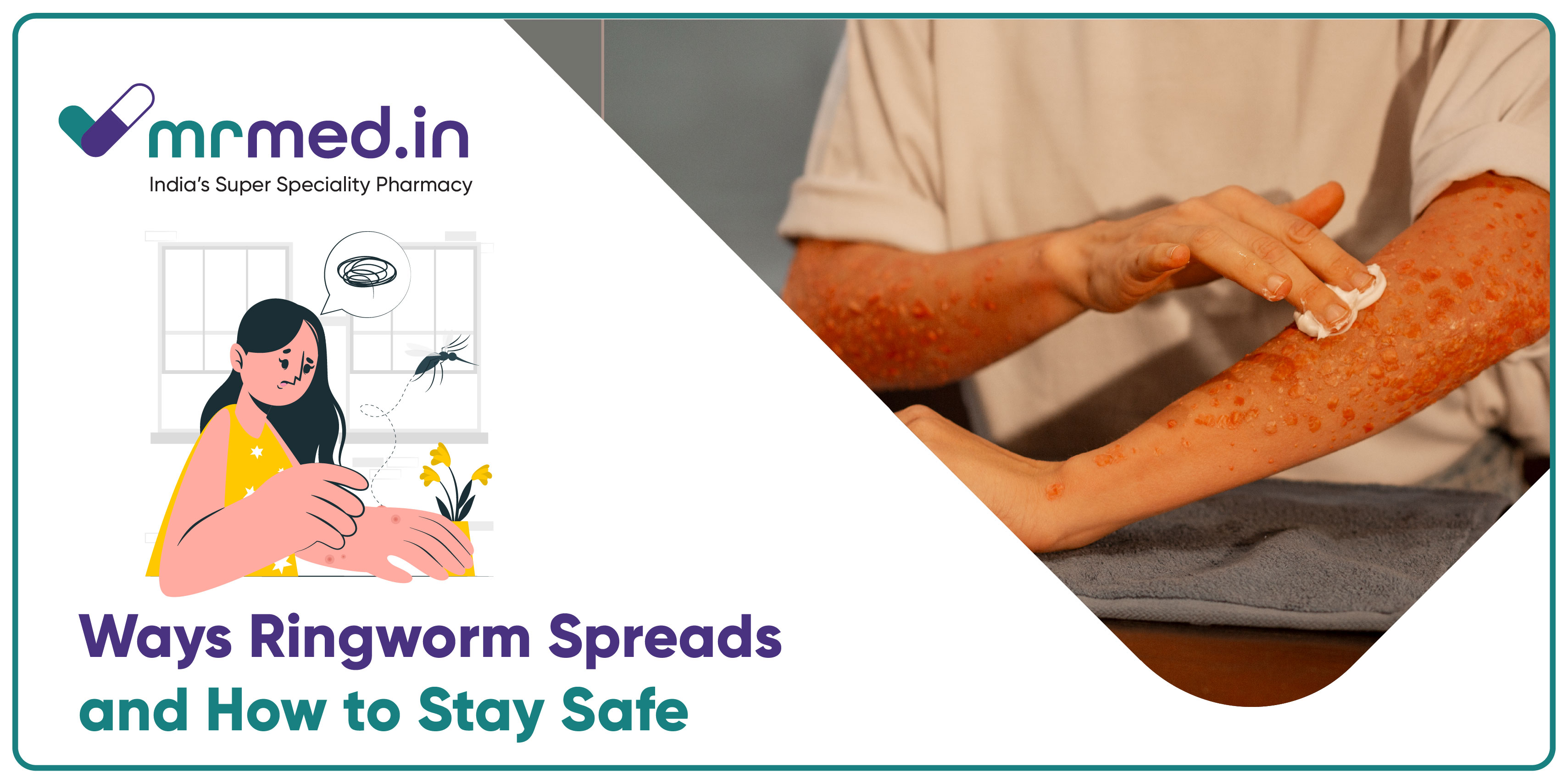 Is Ringworm Contagious? How It Spreads and Prevention Tips