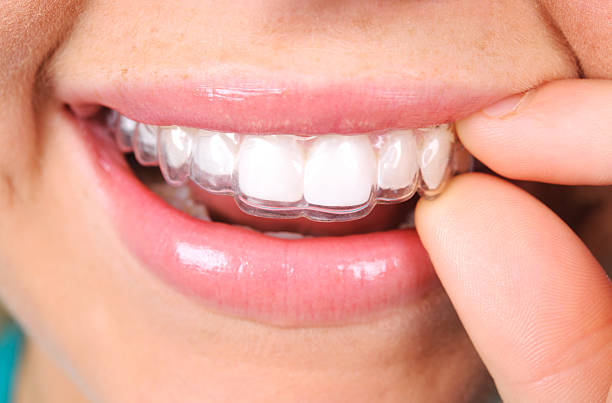 How Invisalign Can Transform Your Smile Without Braces