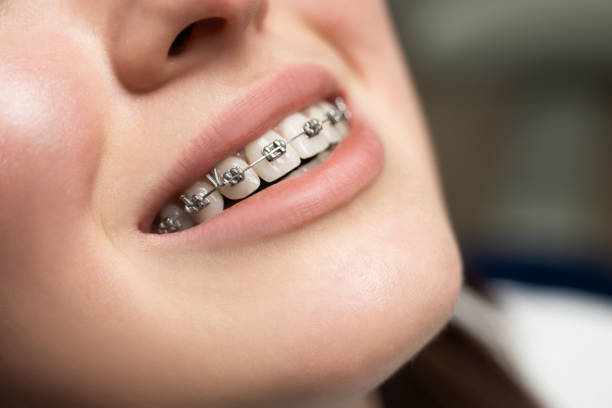 What to Expect When You Get Braces - A Beginner's Guide