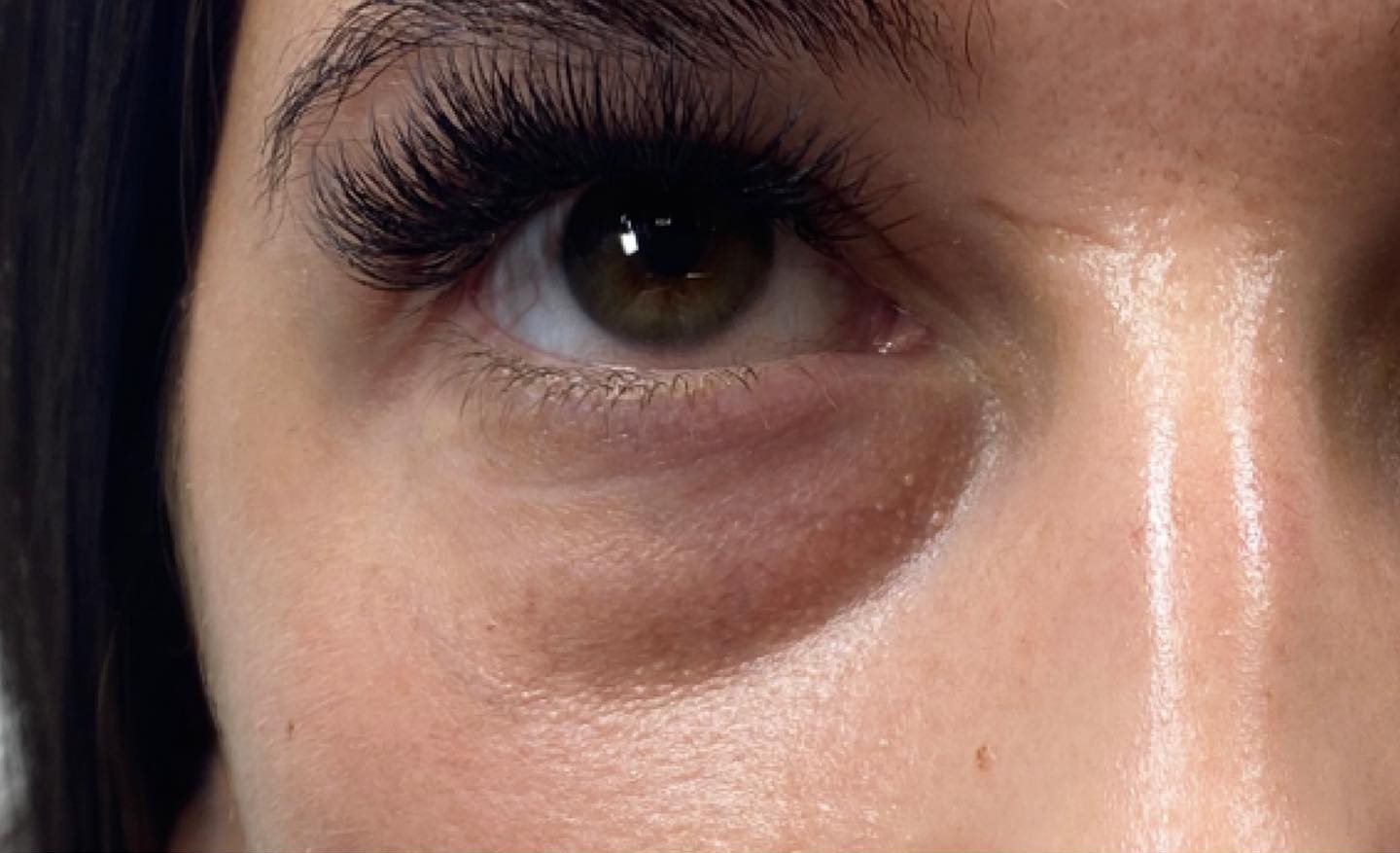 Effective Treatments For Dark Circles Under The Eyes: Solutions For A Refreshed Appearance