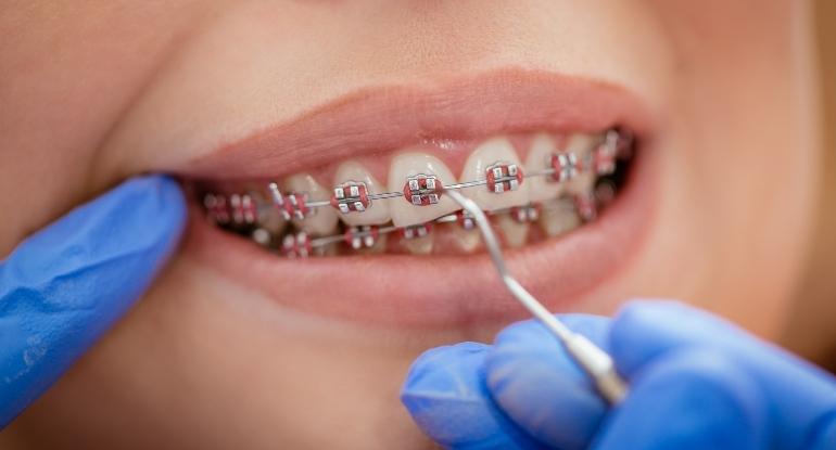Essential Information on Braces Treatment and Long-Term Oral Care