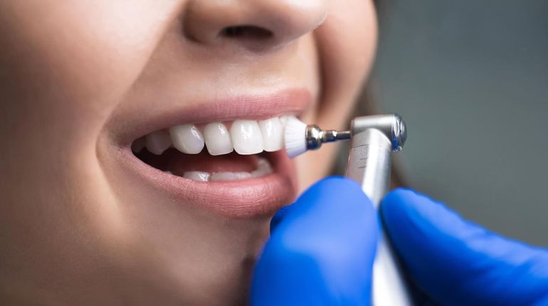 Comprehensive Care Steps and Benefits of Professional Teeth Cleaning