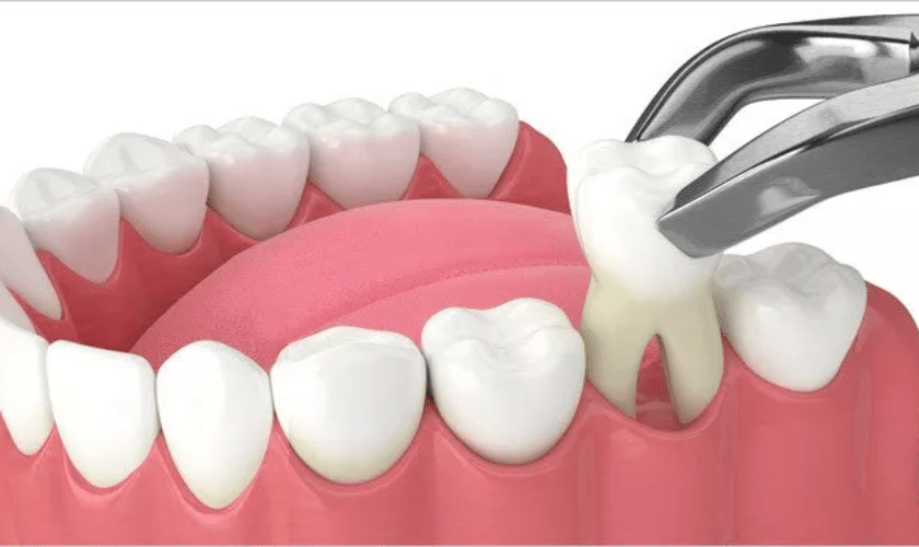 Wisdom Teeth Extraction - Causes, Process, Cost