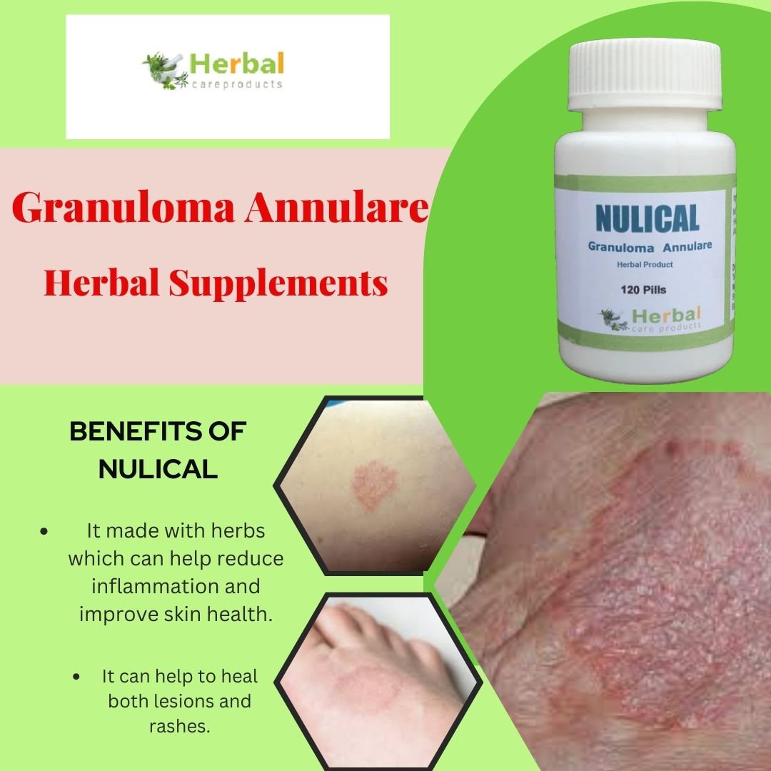 Home Remedies for Granuloma Annulare Prevent Rash and Reddish Bumps