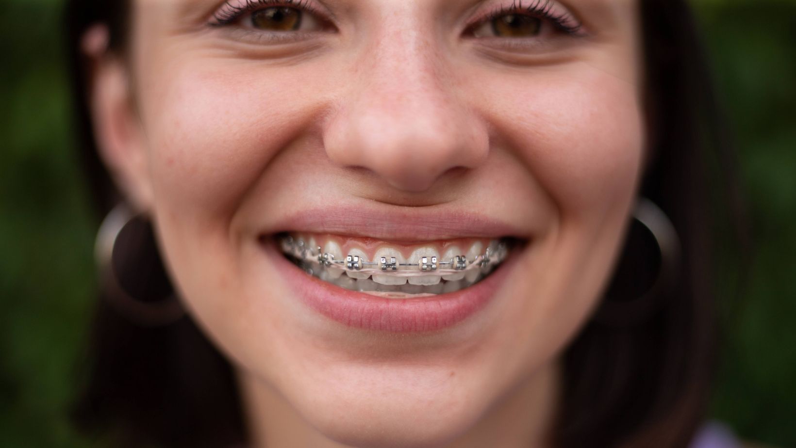 Fix Overbites and Underbites with Orthodontics Braces – Discounted Rates Now!