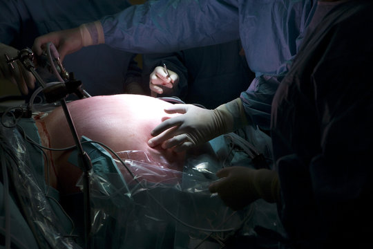 Health Risks Associated with Obesity