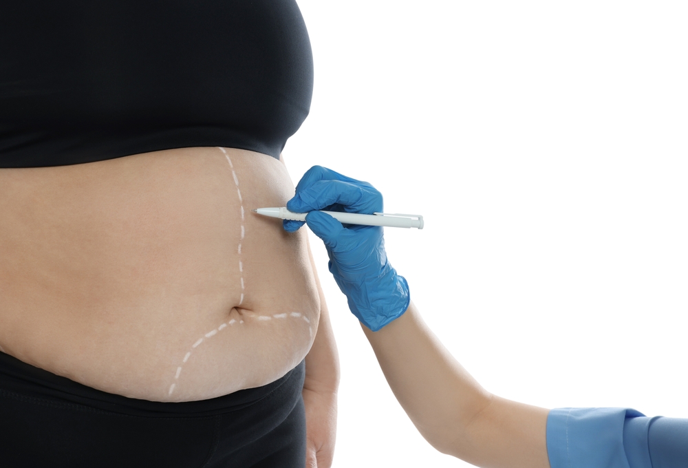 4 Important Factors to Consider Before Bariatric Surgery