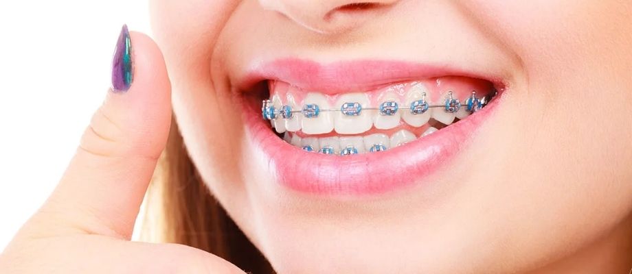 Who Needs Braces Treatment? Signs You Should Know
