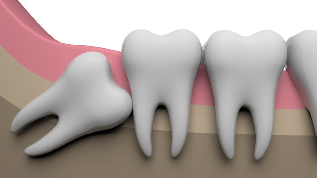 How Painful is Wisdom Teeth Removal?