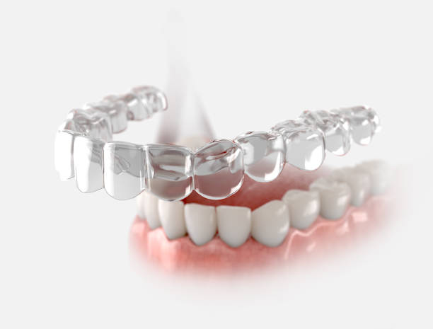 Smile with Confidence: How Invisalign Aligners Work