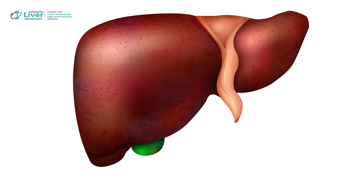 What Is Liver Cirrhosis? Causes, Stages  Treatment Options