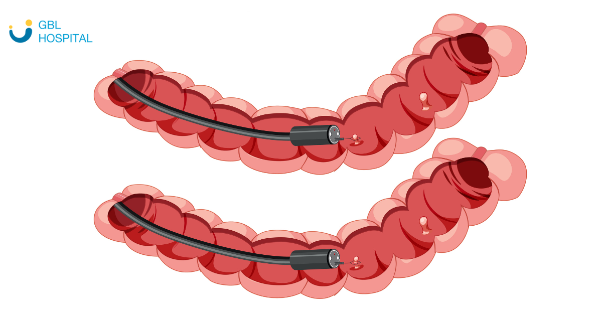 ERCP vs. Endoscopic Ultrasound (EUS): Which Procedure Is Better